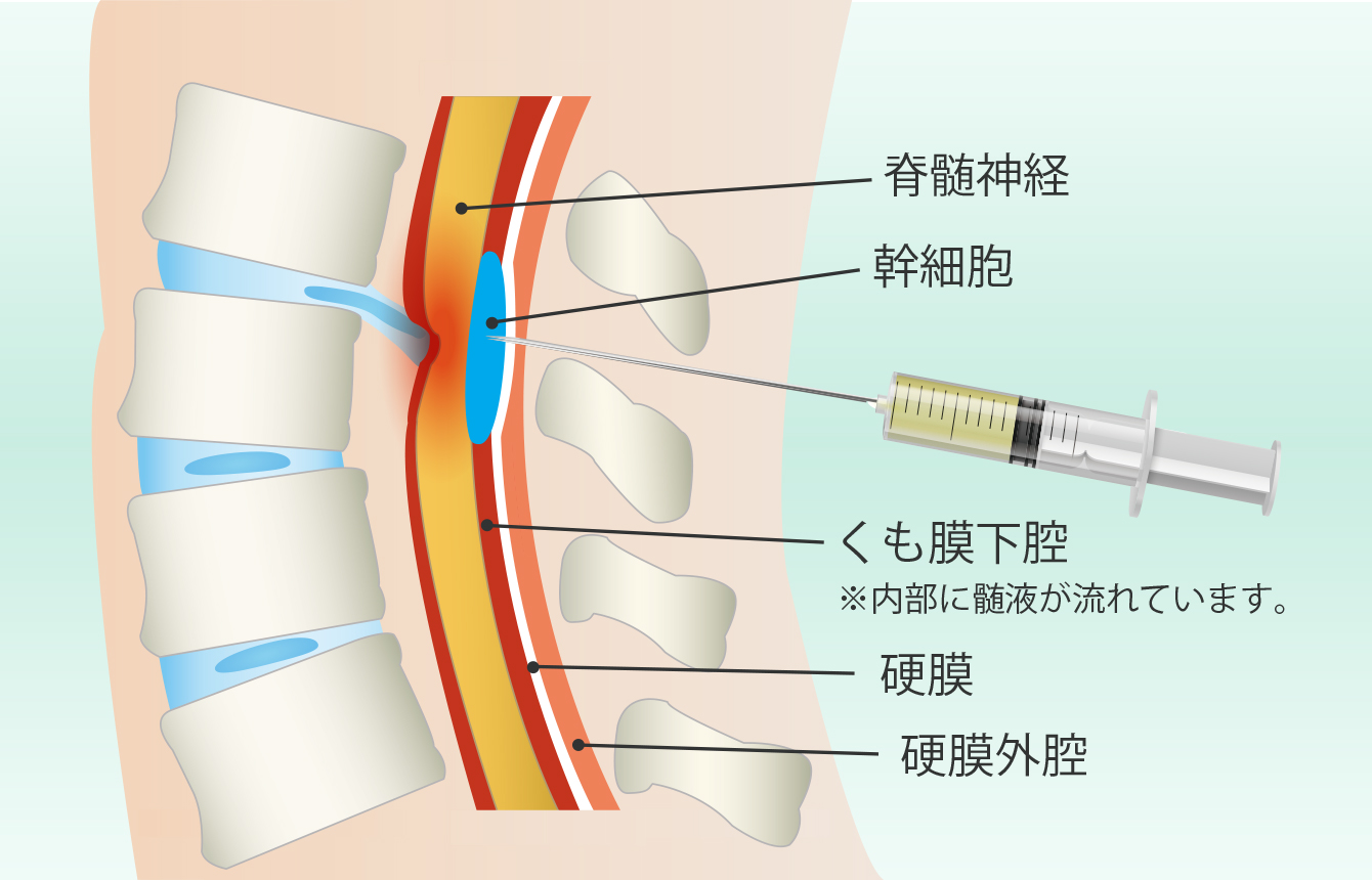 脊髄内への直接投与する幹細胞療法