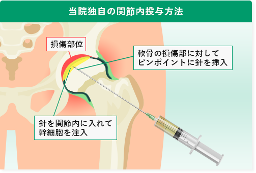 当院独自の股関節内への投与方法