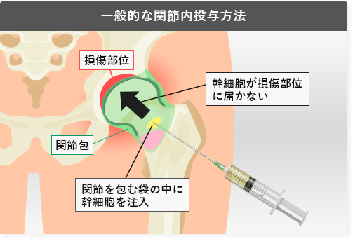 一般的な股関節内投与方法