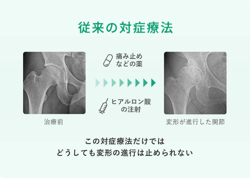 従来の対症療法では、股関節が変形する進行は止められない