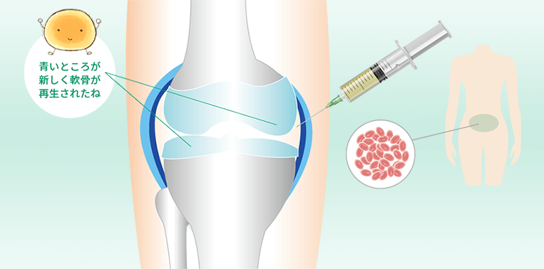 膝の幹細胞治療