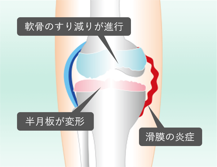 膝の軟骨のすり減りが進行、半月板が変形、滑膜の炎症