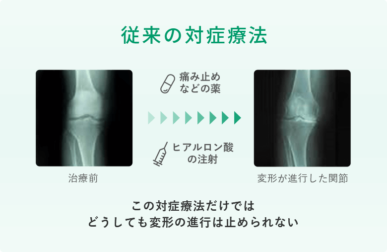 従来の対症療法：痛み止めなどの薬やヒアルロン酸の注射だけではどうしても膝の骨の変形や進行が止められない