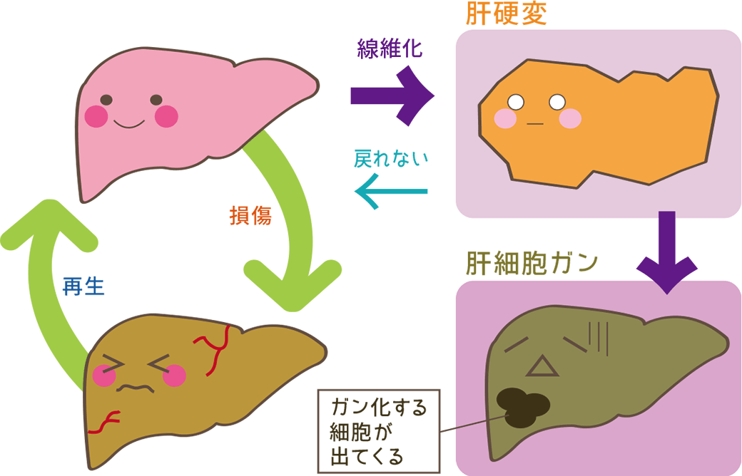 肝線維症や肝硬変を予防できますか?