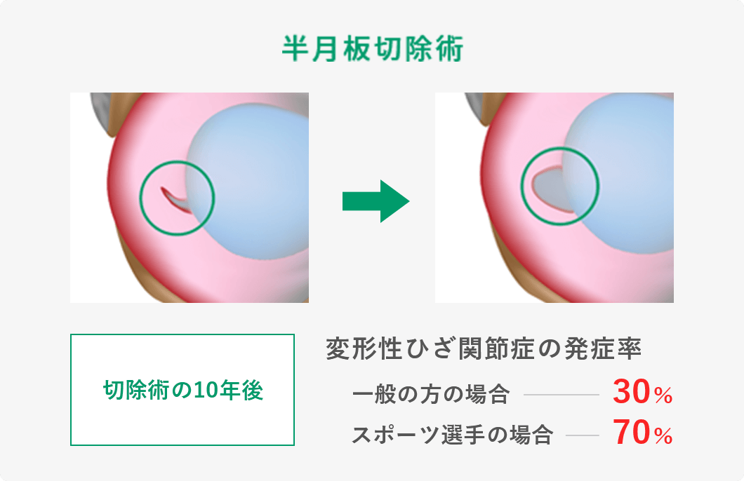 半月板損傷・半月板断裂に対する再生医療・幹細胞治療 | リペアセル 