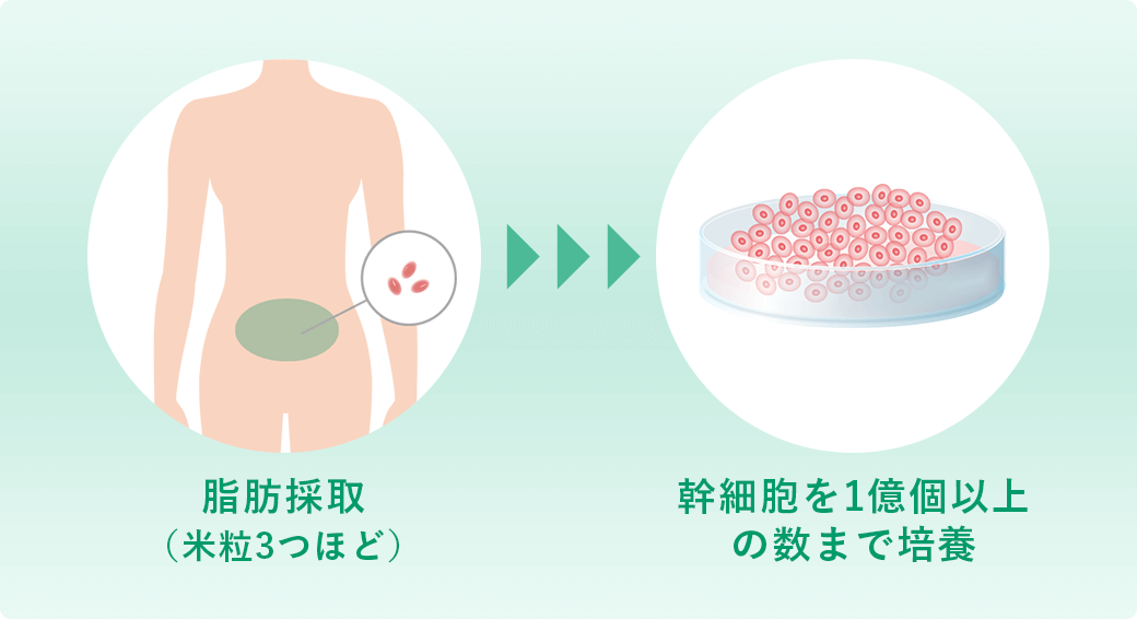 脂肪採取（米粒3つほど）→幹細胞を1億個以上の数まで培養