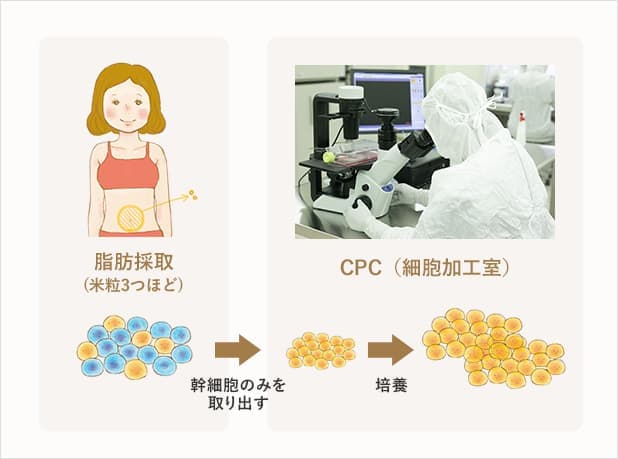 図:脂肪採取の流れ