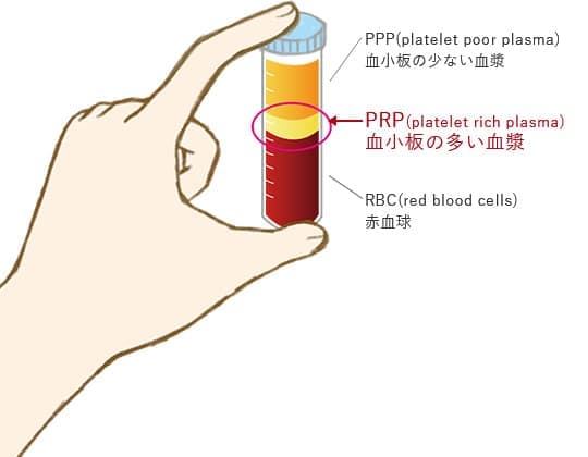 PRP（多血小板血漿）療法