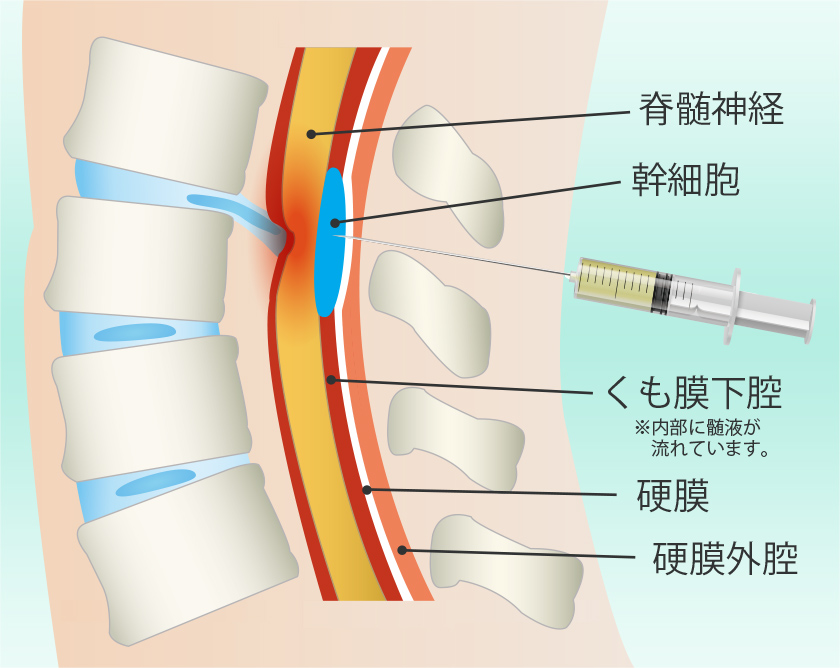 脊髄腔内ダイレクト注射療法