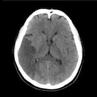 脳卒中の脳梗塞レントゲン図