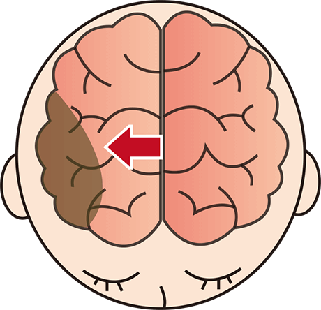 脳卒中(脳梗塞)イメージ