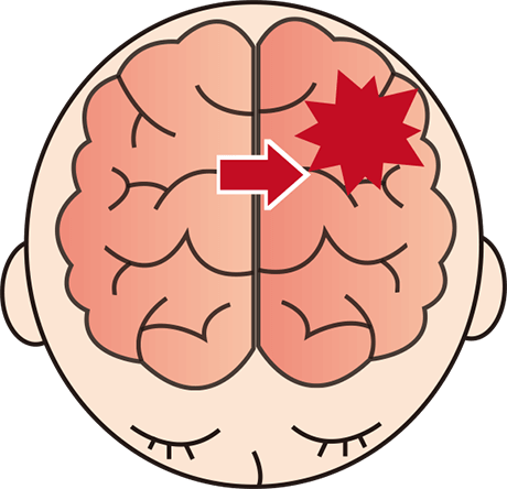 脳卒中（脳出血）のイメージ