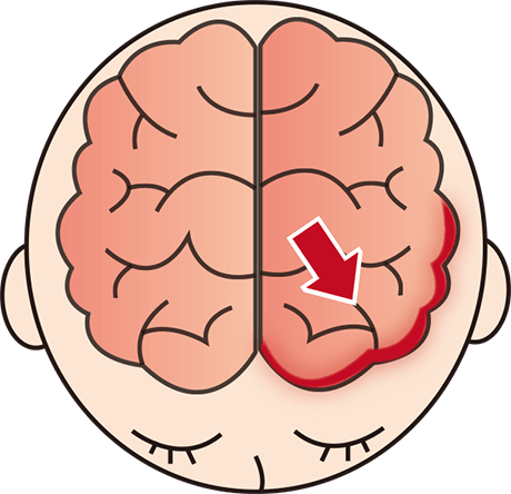 脳卒中(くも膜下出血)イメージ
