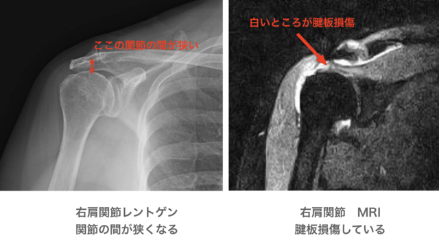 腱板損傷にてPRP施行