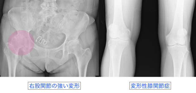 60歳女性 股関節と膝が痛い まだまだ自分の脚で歩きたい リペアセルクリニック東京院