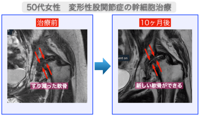 50代女性 治療後10ヶ月で股関節の軟骨が再生 人工関節をさけられた リペアセルクリニック東京院