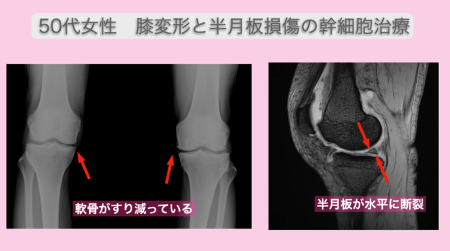 半月板損傷と変形性ひざ関節症に対する再生医療