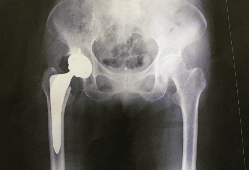 人工股関節　レントゲン