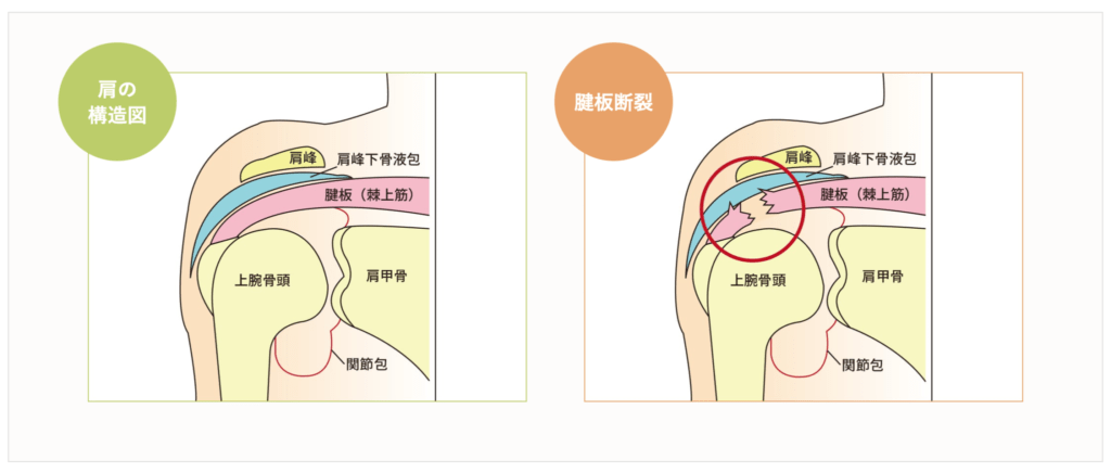 腱板損傷における効果的なリハビリの進め方 リペアセルクリニック東京院
