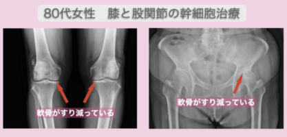 膝と股関節の幹細胞治療