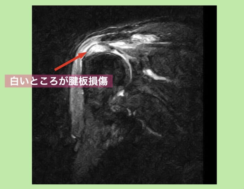 肩腱板損傷MRI画像