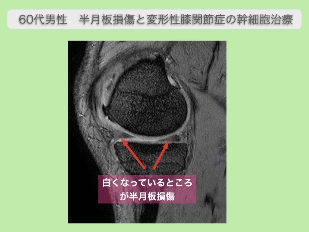 半月板損傷と変形性膝関節症に対する幹細胞治療