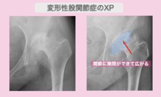 変形性股関節症の幹細胞治療