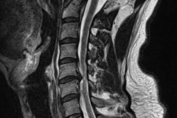 脊髄損傷に対する脊髄内幹細胞投与