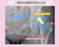 変形性股関節の幹細胞治療