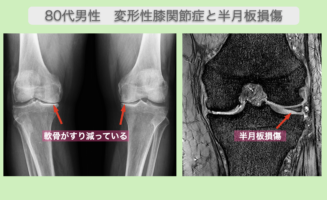 変形性膝関節症と半月板損傷の再生医療