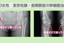 変形性膝関節症と変形性股関節の再生医療