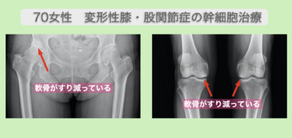 変形性膝関節症と変形性股関節の再生医療