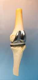 人工膝関節