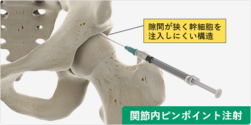 股関節への関節内ピンポイント注射は当院独自