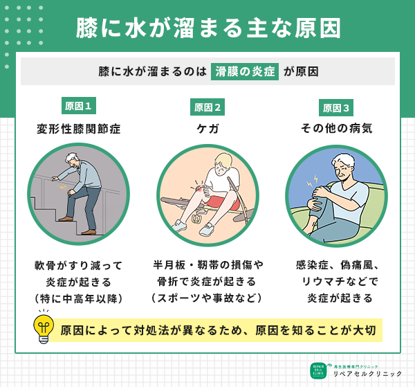 膝に水が溜まる主な原因