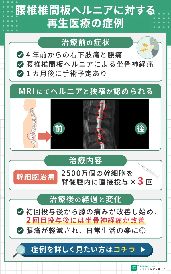 腰椎椎間板ヘルニア症例