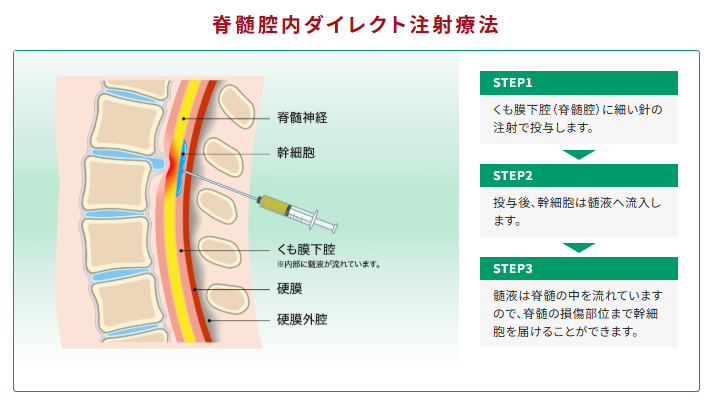 脊髄腔内ダイレクト注射療法