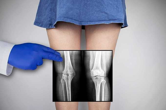 変形性股関節症の膝