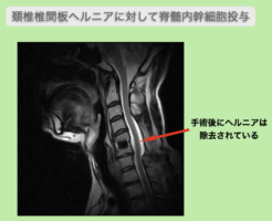頸椎椎間板ヘルニアの再生医療