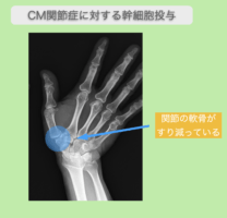CM関節症に対する再生医療