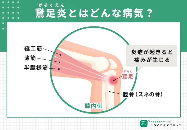鵞足炎とは