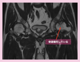 大腿骨頭壊死の再生医療