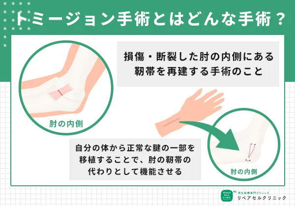 トミージョン手術とは