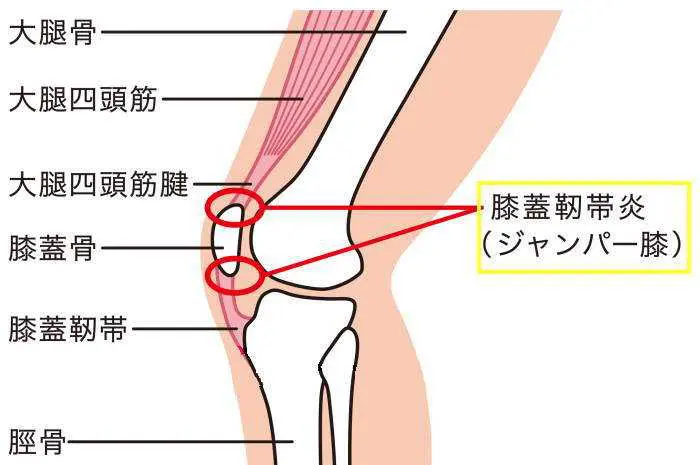 ジャンパー膝といわれる大腿四頭筋腱付着部炎の原因と治療 リペアセルクリニック東京院