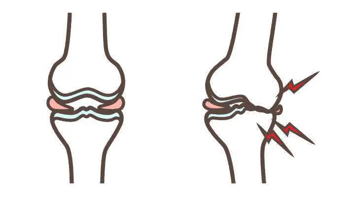 半月板損傷の手術 そのメリットと デメリット リペアセルクリニック東京院