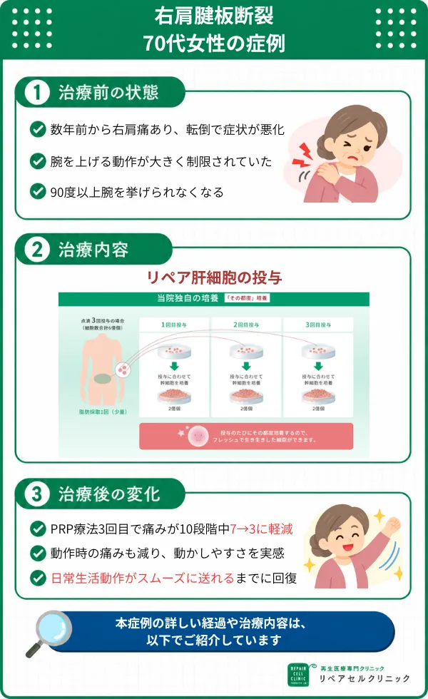 腱板断裂の症例画像