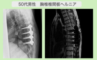 胸椎椎間板ヘルニア術後の痺れ完全消失！片足ジャンプも可能に！ 50代男性 | リペアセルクリニック東京院