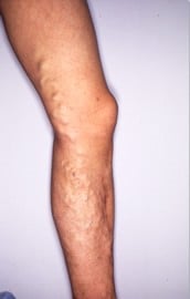 下肢静脈瘤の写真