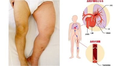 深部静脈血栓症の写真と図