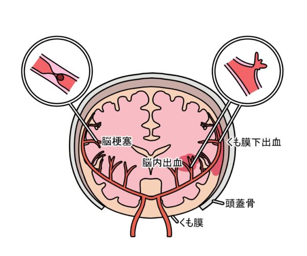 出血性脳卒中の症状
